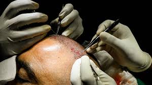 زراعة شعر تنتهي بمأساة: وفاة رجلين في الهند بعد عمليات فاشلة تثير غضبًا واسعًا